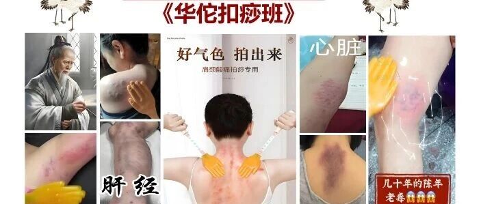 【第九期华佗扣痧疗法集训班】